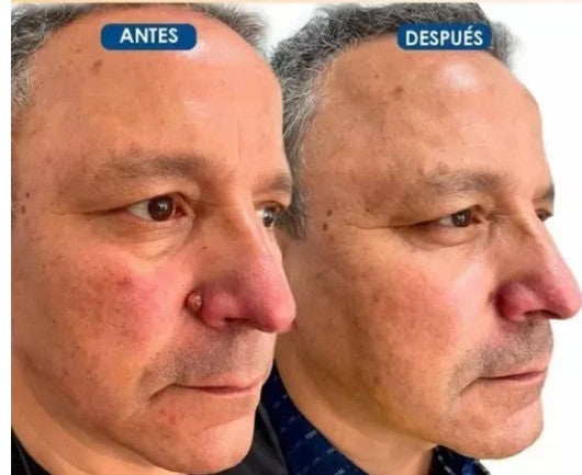 FormuClear™ - Elimina verrugas sin dolor y seguro + ENVIO GRATIS