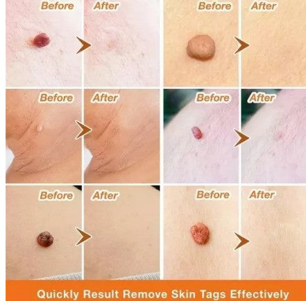 FormuClear™ - Elimina verrugas sin dolor y seguro + ENVIO GRATIS