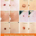 FormuClear™ - Elimina verrugas sin dolor y seguro + ENVIO GRATIS